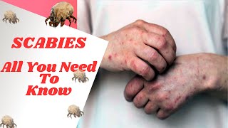 How To Identify amp Treat Scabies Causes Symptoms Prevention  Permethrin Ivermectin [upl. by Hsinam]