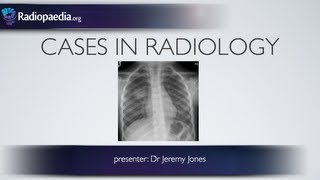 Cases in Radiology Episode 3 pediatric chest xray [upl. by Kcirdec]