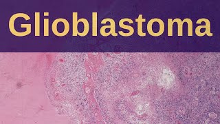 What is a Glioblastoma  Pathology mini tutorial [upl. by Yelserp696]