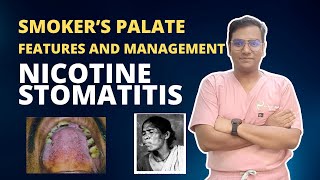 Dr Rudra Mohan  Nicotine Stomatitis Papules Spots on Palate due to smoking Smokers Palate [upl. by Brothers]