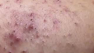 Huge blackhead removal from nose old aged blackheads removal  blackheads new this week 2023 6 [upl. by Swarts]