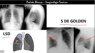 Achados de Imagem na Atelectasia Pulmonar [upl. by Allekram]