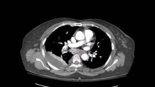 Radiology Rounds  radRoundscom A Radiologist Auntminnie  CT Pulmonary Embolism [upl. by Onibag484]