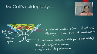 Pelvic organ prolapse  apical repair by Dr Anjali Kawthalkar [upl. by Leamsi]