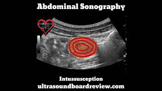 Intussusception Ultrasound [upl. by Elagiba]