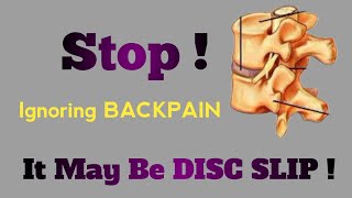 What Is Disc In Spine amp How It Becomes Herniated [upl. by Peggy40]