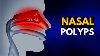 NASAL POLYPS Causes SIgns and Symptoms Diagnosis and Treatment [upl. by Ford]