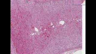 Histopathology AdrenalCortical adenoma [upl. by Eannyl753]