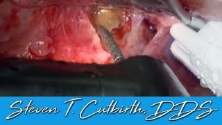 Apicoectomy of Infected Tooth with PRF amp Phlebotomy [upl. by Woodall653]