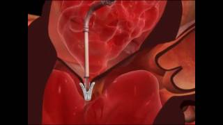 Mitral Valve Clip Repair ProcedureHow It Works [upl. by Alihs275]