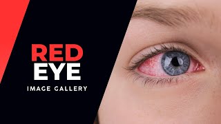 Red Eye Image Gallery [upl. by Yaron669]