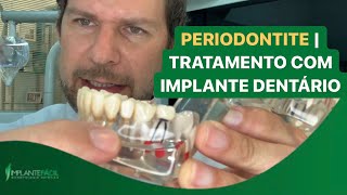 Periodontite  Tratamento com Implante Dentário [upl. by Sly535]