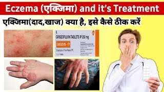 Eczema treatment in Hindi  What is eczema in hindi  Atarax injection  hydralazine 25 mg tablet [upl. by Ralyt]