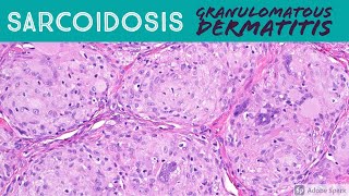 Sarcoidosis amp Granulomatous Dermatitis Pattern  Inflammatory Dermatopathology Basics [upl. by Retsehc]