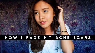 How To Fade Acne Scars  Banish Skincare Review [upl. by Dierolf]