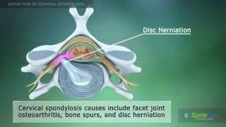 Cervical Spondylosis Definition [upl. by Morocco]