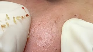 Acne treatment for Spa Linh Mun 2024 27 [upl. by Enicul]