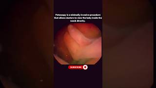 Real Time Video of What Baby Do in the Womb 🥰 Fetoscopy [upl. by Nahtnoj]