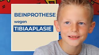 Moritz Weg mit Tibiaaplasie Dysmelie Orthoprothese KnieexProthese Badeprothese [upl. by Nedrah]