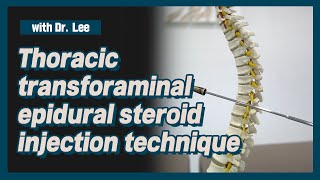 TThoracic transforaminal epidural steroid injection technique [upl. by Inalak]