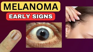 6 Weird Signs That You Have Melanoma [upl. by Barton]