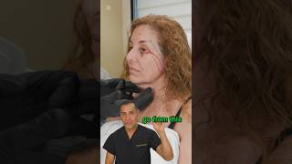 AMAZING Deep Plane Facelift Results antiaging beforeandafter beauty facelift skincare cosmetic [upl. by Eerac582]