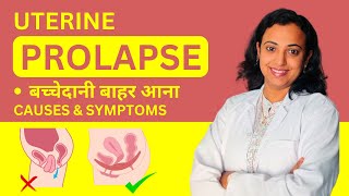 Uterus Prolapse  Symptoms amp Diagnosis  Uterine Prolapse Kya Hota Hai Kaise Thik Kare [upl. by Erreit644]