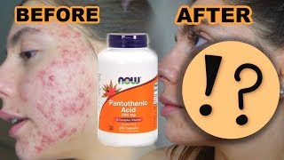 3 MONTHS OF TAKING PANTOTHENIC ACID FOR MY ACNE IS IT WORTH IT [upl. by Juliano]