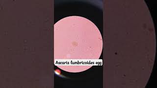 Ascaris lumbricoides egg  A case of Ascariasis [upl. by Ducan]