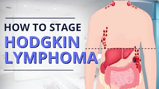 Hodgkin Lymphoma Staging From Diagnosis to Prognosis  The Patient Story [upl. by Corinne]