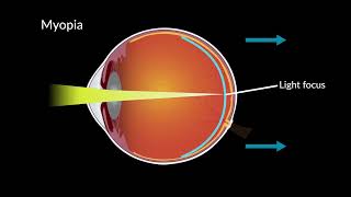 Myopia and Eye Development [upl. by Niwred]