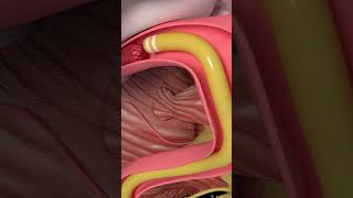 Thrombectomy [upl. by Berga]