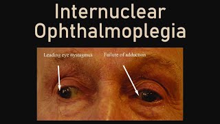 Internuclear Ophthalmoplegia [upl. by Aika168]