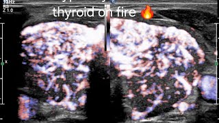 How to Differentiate Hashimotos Thyroiditis vs Hyperthyroidism on Ultrasound amp Doppler ultrasound [upl. by Raclima627]