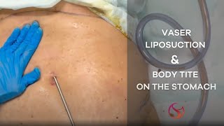 Vaser Liposuction and BodyTite on the Stomach  Dr Shalini Gupta [upl. by Nnaecarg]