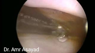 Endocervical polyp and Nabothians Cyst [upl. by Garling]