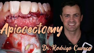 Apicoectomy Surgical method of root canal treatment DrRodrigo Cavaco [upl. by Heisser]