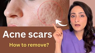 How to reduce Acne Scar  Chemical peels Dermaroller Lasers  Cost  Dermatologist Dr Aanchal [upl. by Leandra]