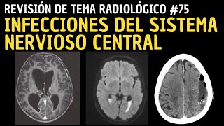 Revisión de Tema 75 Infecciones del sistema nervioso central SNC [upl. by Crompton877]