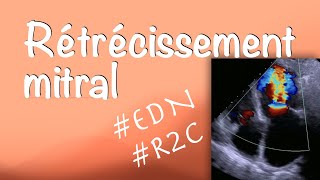 Rétrécissement mitral  Valvulopathies cardiaques item N°233 [upl. by Shela926]