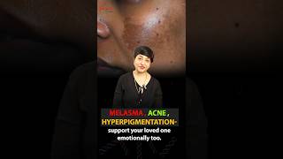 Acne Melasma Hyperpigmentation  How Skin Problems Can Lead to Depression Support amp Understanding [upl. by Yrkcaz440]