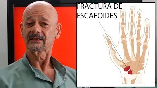 Fractura del hueso escafoides de la muñeca [upl. by Arteid]