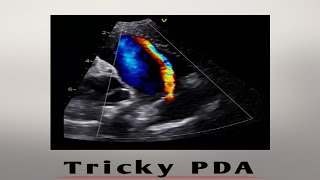 Tricky Patent ductus arteriosus PDA pediatric echo [upl. by Ynnavoj]