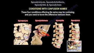 Spondylolysis Spondylolisthesis Spondylitis SpondylosisEverything Need To KnowDr Nabil Ebraheim [upl. by Attelliw]