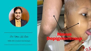 Nevus Depigmentosus  White birth mark and its treatment Skin me safed dag ka karan aur ilaz [upl. by Irakuy]