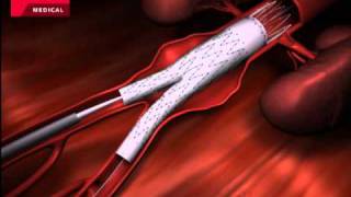 CARDIOLOGIA  ZENITH  ANEURISMA AÓRTICA ABDOMINAL AAA  COOK [upl. by Carter]