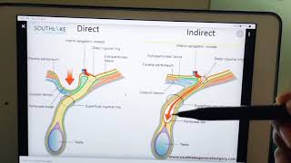 direct vs indirect inguinal hernia [upl. by Etnaled891]