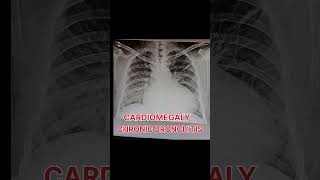 Cardiomegaly and chronic bronchitis shortvideo [upl. by Olracnaig]