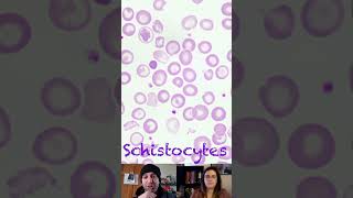 Schistocytes vs Acanthocytes vs Echinocytes [upl. by Zuliram]