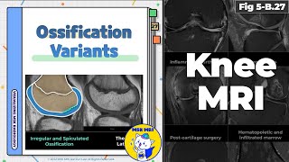 Fig 5B27 Types of Ossification Variants of the Knee [upl. by Ecinert]